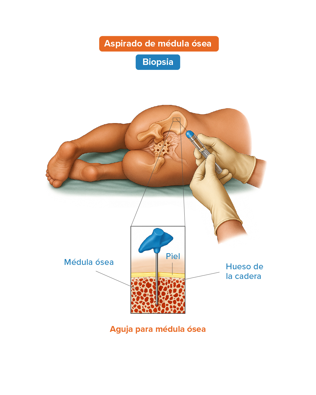 Aspirado de medula osea 1