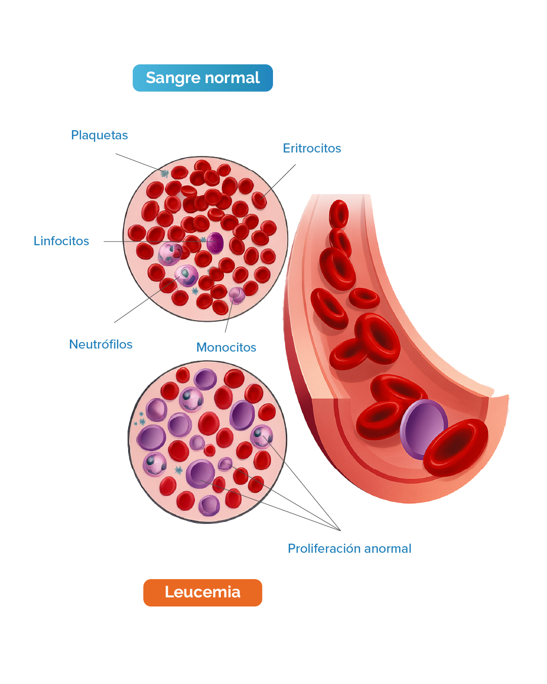 Leucemia 1