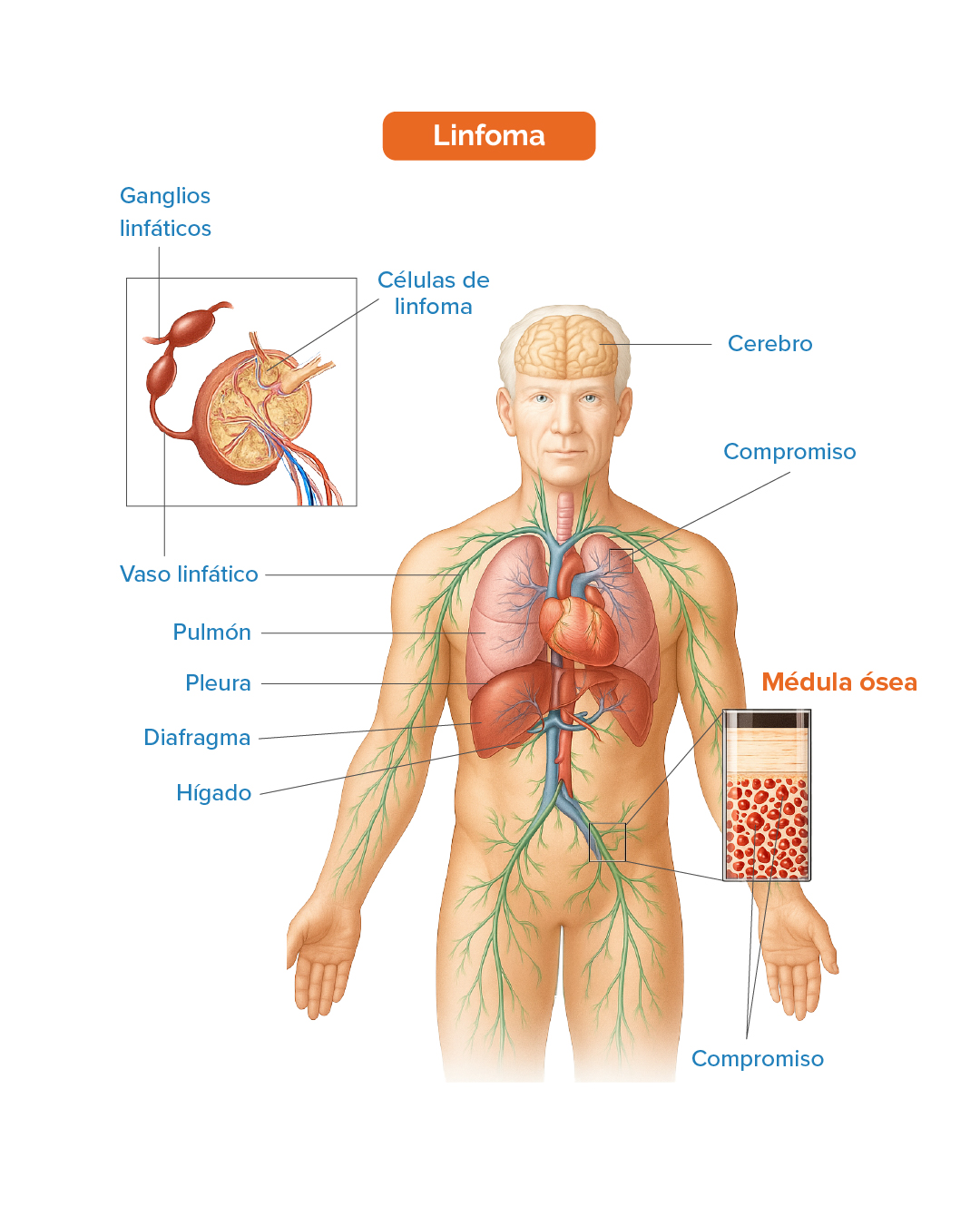 Linfoma 1
