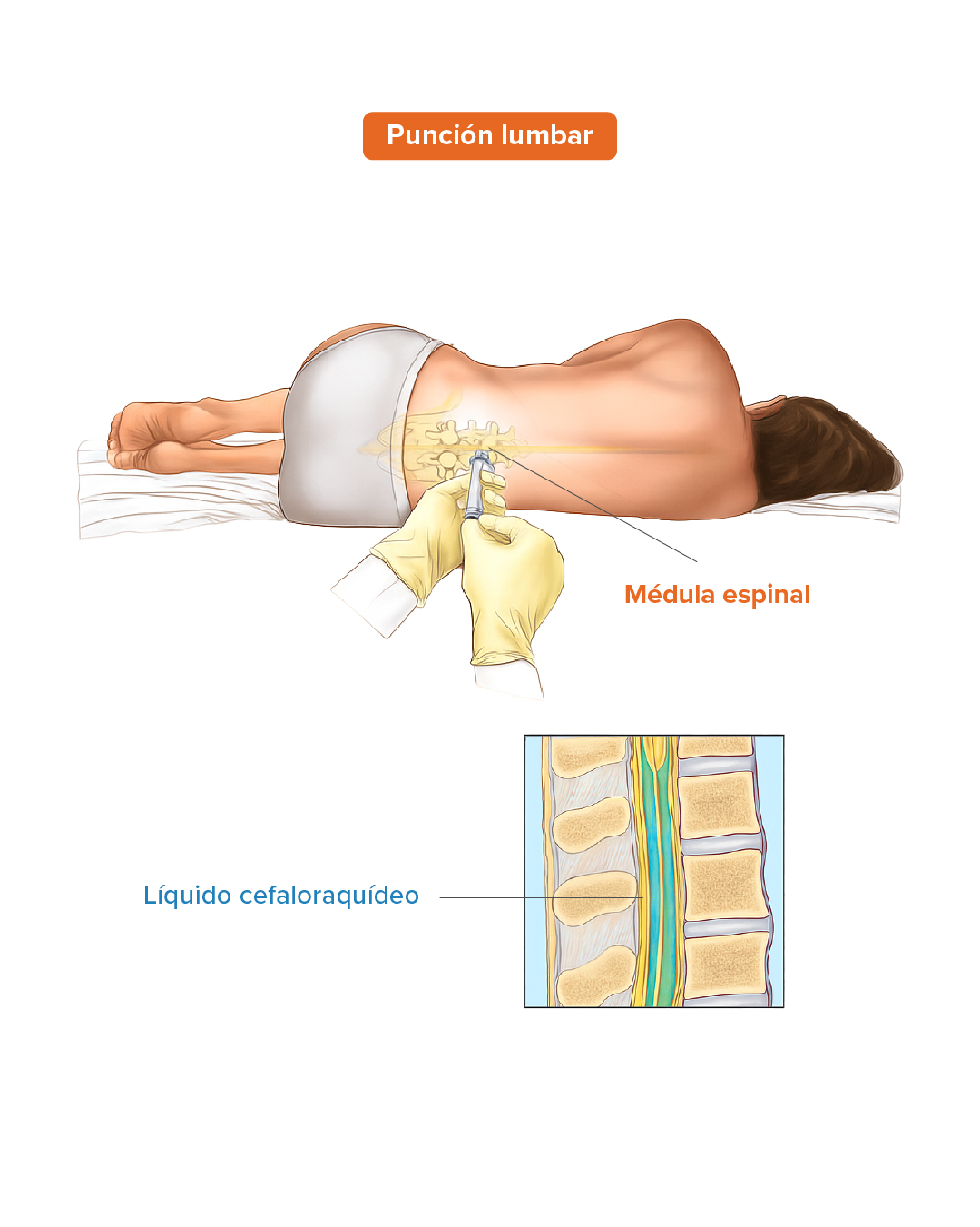 Puncion lumbar 1